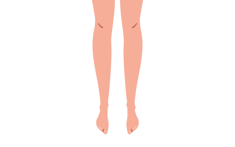 Legs with no visible swelling. Legs with no visible swelling.